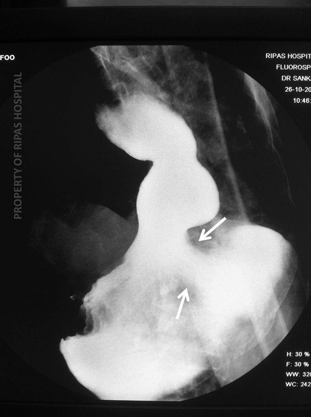 gastric cancer x ray cum să tratăm papilomele în nas